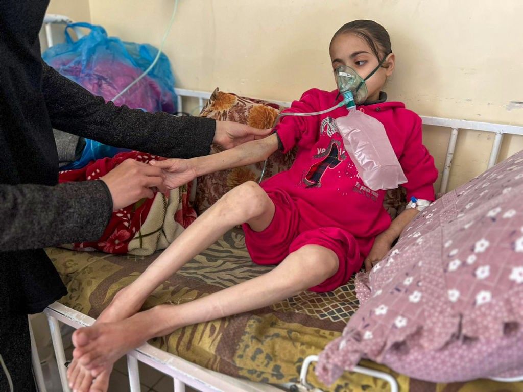 An emaciated Palestinian girl struggles to survive malnutrition in a Gaza hospital